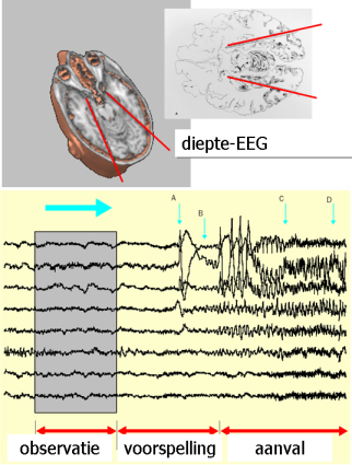 EEG spike